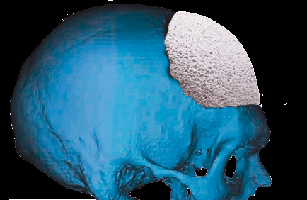 CustomBone Finceramica